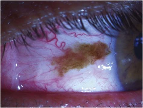 Left eye: conjunctival melanosis. | Download Scientific Diagram