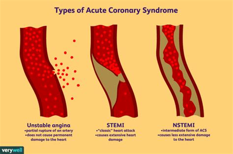 NSTEMI: Non-ST-Segment Myocardial Infarction Explained