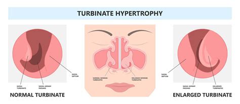 Large Inferior Turbinate: Symptoms, Causes, Diagnosis, and Treatment