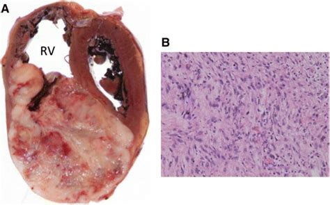 Malignant phyllodes tumor metastasized to the right ventricle: a case report | Surgical Case ...