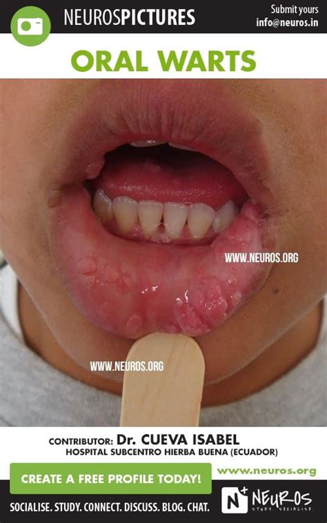 Oral Warts in a 12 year old boy | Clinical Case in Images | Pinterest | Boys, Year old and 12 ...