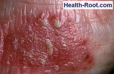 Pustular psoriasis 🏥 Disease, Symptoms, Treatment. 2021