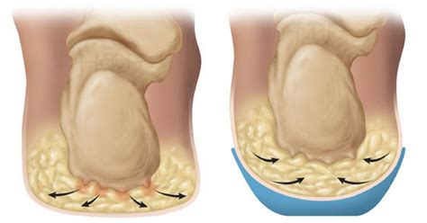 Heel Fat Pad Syndrome and Treatment | Heel That Pain