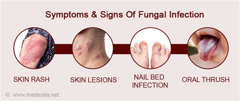 All of the Following Are Fungal Infections Except - RexkruwRhodes