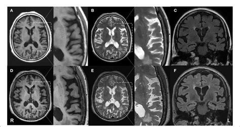 FIGURE Progressive brain atrophy was detected by structural MRI. First... | Download Scientific ...