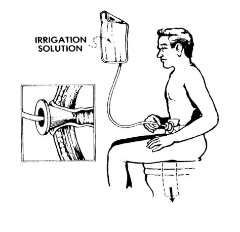 Seeking Healthy Life: Colostomy Irrigation