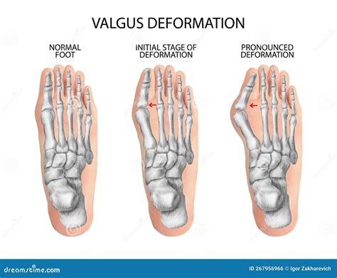 Valgus Deformity of the Toes. Stock Illustration - Illustration of ...