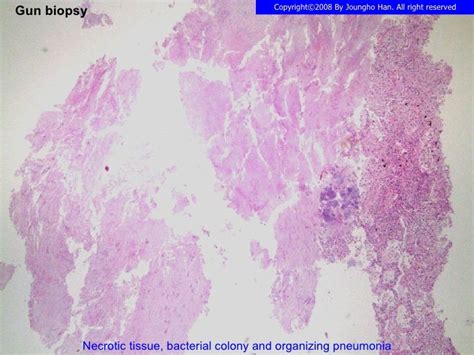 Actinomycosis lung