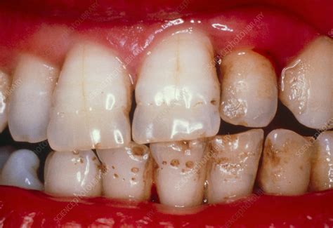 Pitted teeth: hypoplasia of the enamel - Stock Image - M782/0044 - Science Photo Library