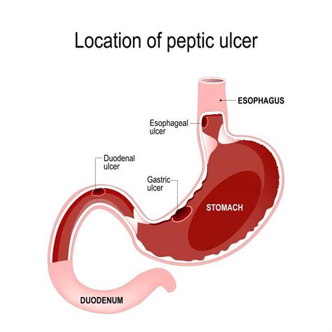 Nausea and Vomiting Singapore - Alpine Surgical | Dr Aaron Poh