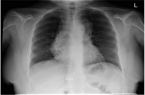 Thymic carcinoma presenting as atypical chest pain -- Siddiqui et al. 2015 -- BMJ Case Reports