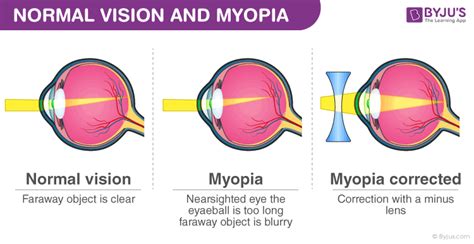 Eye Defects - Myopia Its Causes, Symptoms, and Treatment