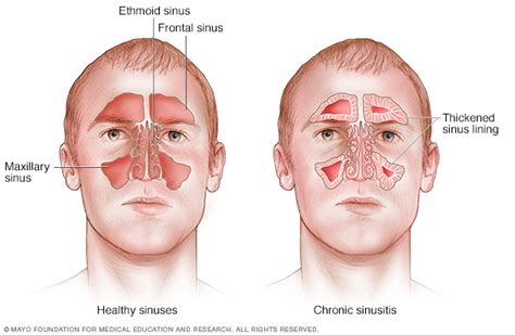 Acute sinusitis Disease Reference Guide - Drugs.com