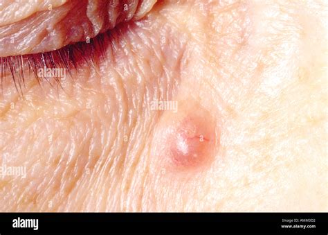 Basal cell carcinoma BCC on face Stock Photo - Alamy