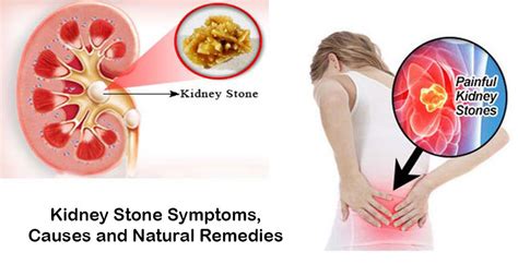 Kidney Stone Symptoms, Causes and Natural Remedies | BestHerbalHealth