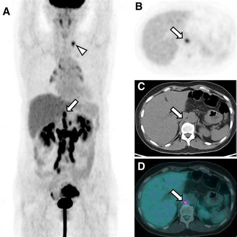 Retrocrural Lymph Node Metastasis Disclosed by (18)F-FDG PET/CT: A Predictor of Supra ...