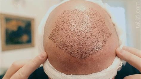 FUE Hair Transplant Procedure, Advantages, and Cost | Adorable Clinic