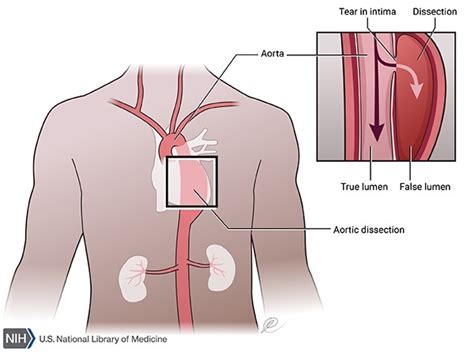 Marfan syndrome: MedlinePlus Genetics