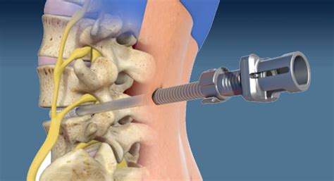 Minimally Invasive Procedure to Alleviate Low Back and Leg Pain - Mega Doctor News