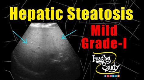 Liver Steatosis Ultrasound