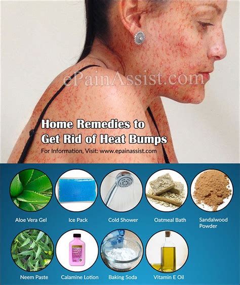 Heat Rash Remedies For Adults