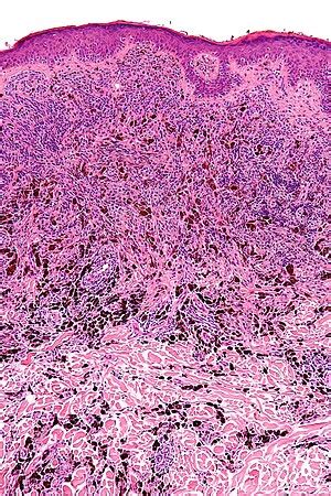 Congenital Nevus Histology