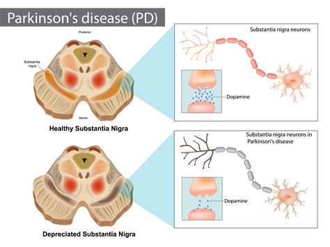 Parkinson's disease. Normal and Depreciated Substantia Nigra ...