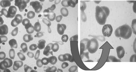 Peripheral blood smear showing many hypochromic and microcytic cells ...