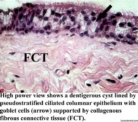 Dentigerous Cyst Definition, Clinical Features, Types, Radiographic features, Treatment