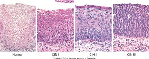 Cervical Cancer - Stepwards