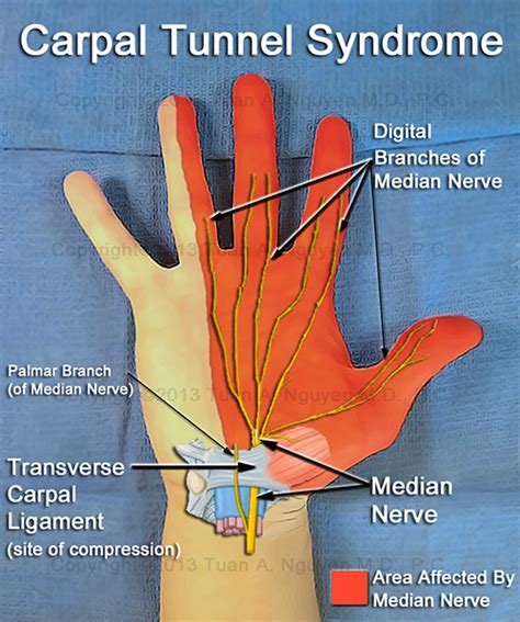 About Carpal Tunnel Syndrome - Lake Oswego Hand Surgery - Portland, Oregon