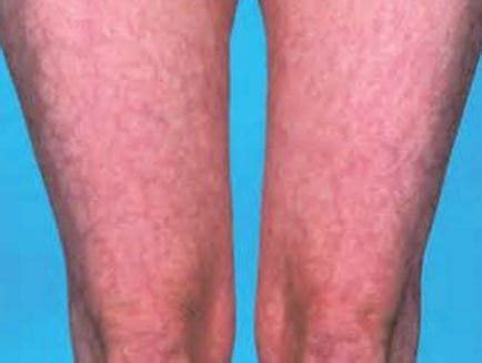 Livedo Reticularis - Causes, Pictures, Treatment, Symptoms