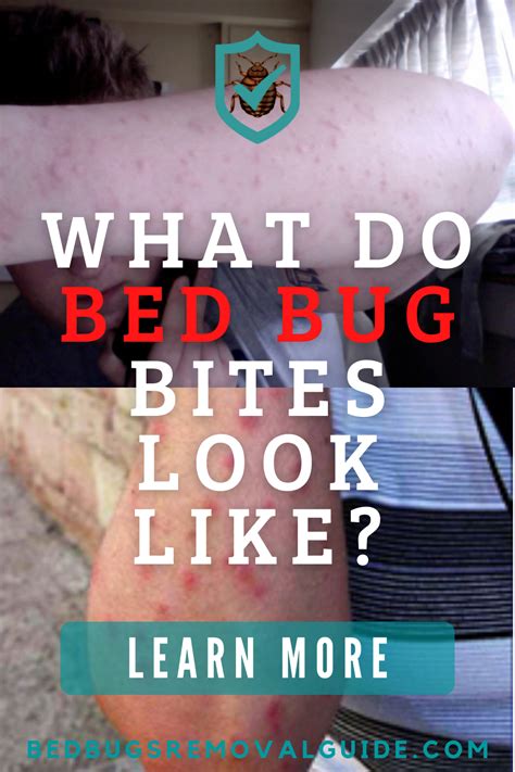 What do bed bug bites look like? in 2022 | Bed bug bites, Bed bugs, Bug bites