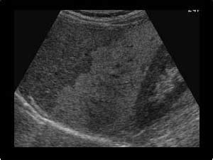 Abdomen and retroperitoneum | 1.1 Liver : Case 1.1.11 Fatty liver and focal sparing | Ultrasound ...