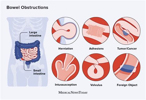 Bowel obstruction: Symptoms, causes, treatment, and diet