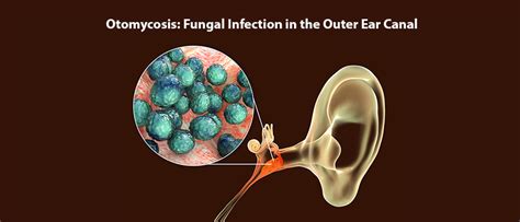 Otomycosis - Defination, Causes, Symptoms & Treatment | Truemeds