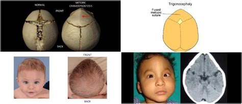 Metopic Synostosis: Causes, Symptoms, Diagnosis, and Treatment - Hoool ...