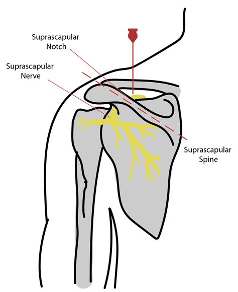 Suprascapular Nerve Block Article