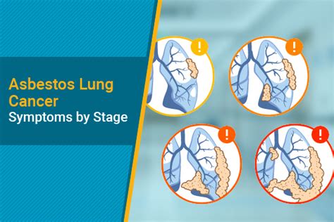 Asbestos Lung Cancer Symptoms by Stage | Mesothelioma Guide