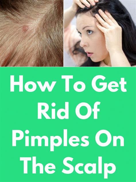 Fun Tips About How To Treat Scalp Pimples - Commonlab23