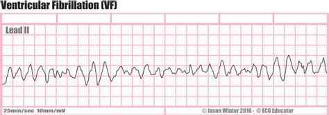 What is Ventricular Fibrillation (V-Fib)? - Boss RN