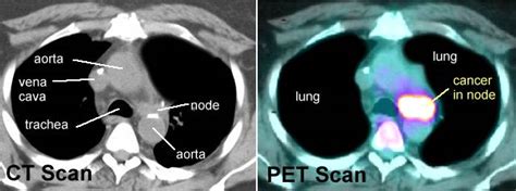 PET Scans in Cancer Cases