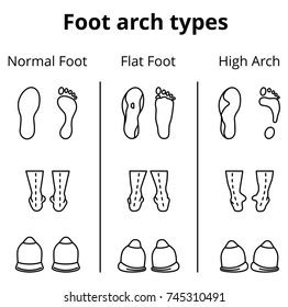 Foot Arch Types Vector Infographics Set Stock Vector (Royalty Free ...