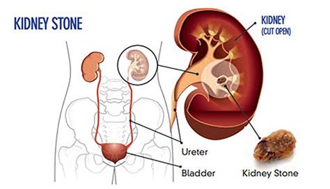 10 Causes of Kidney Stone – New Life Ticket