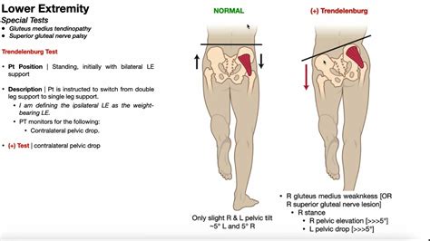 Trendelenburg Test | Rationale & Interpretation - YouTube