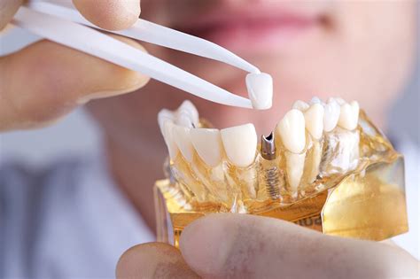 How to Avoid Potential Dental Implant Complications | Absolute Dental