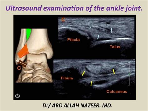 Presentation1.pptx. ultrasound examination of the ankle joint. | PPT