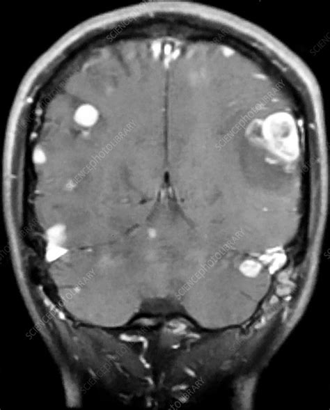 Melanoma Metastatic to Brain, MRI - Stock Image - C039/4209 - Science Photo Library