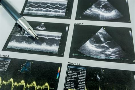 Stress Echocardiography Safe for ED Triage of Chest Pain - The Cardiology Advisor