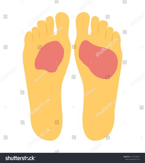 diabetic foot pain and ulcer, skin sores on - Royalty Free Stock Vector 1157776927 - Avopix.com